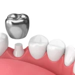 how to care for your dental crown and prevent costly infections.