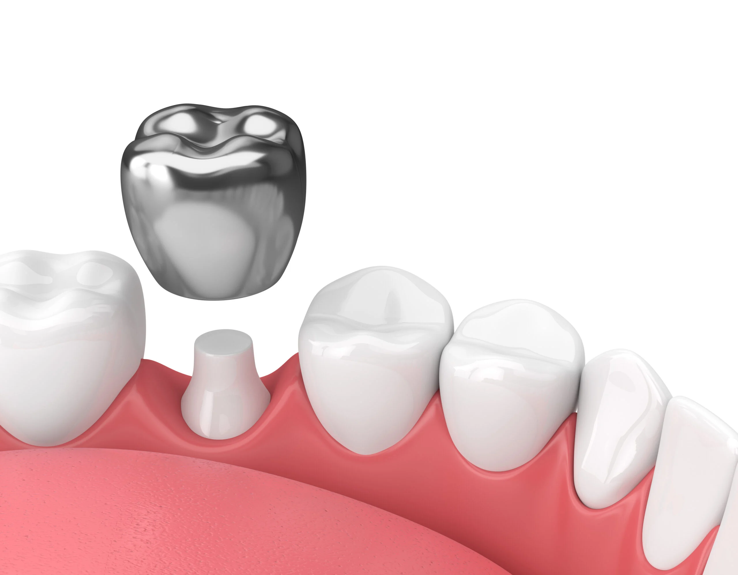 how to care for your dental crown and prevent costly infections.