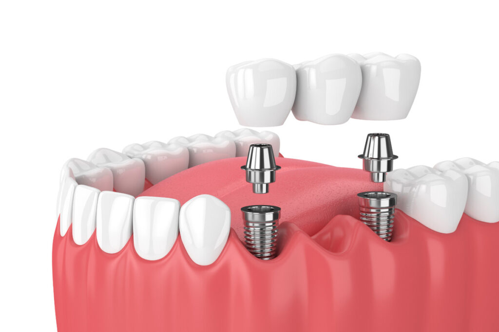 Dental implants procedure restoring a confident and healthy smile at Caring Dental Services. Dental implants procedure restoring a confident and healthy smile at Caring Dental Services. Dental implants procedure restoring a confident and healthy smile at Caring Dental Services.